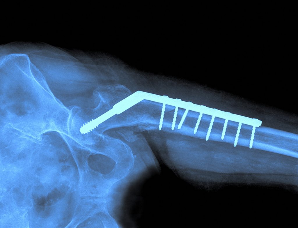 X-ray of the hip prosthesis